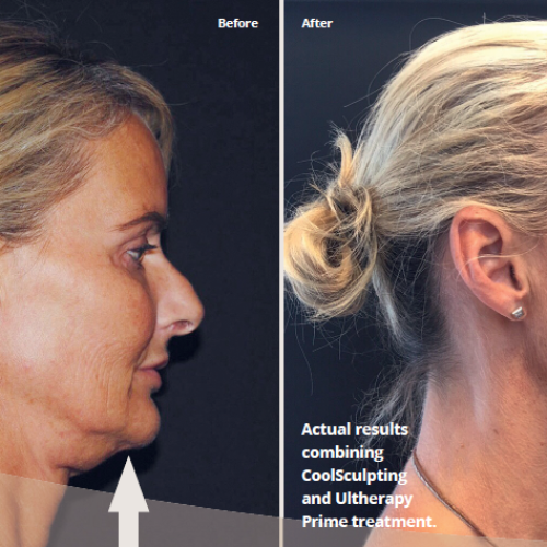 iBeauty – Real lasting results with Ultherapy Prime
